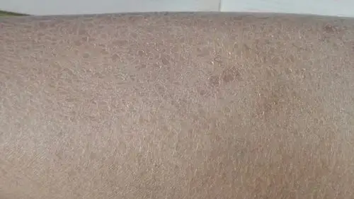 腿上皮肤是这样的.只有小腿.这是什么情况.涂上润肤露也不太管用.