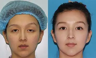 眼睑下垂的分类