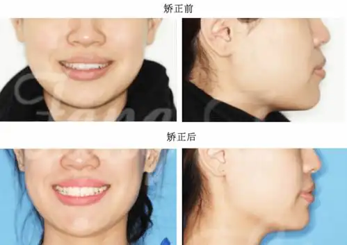 矫正前后面像对比