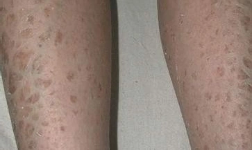 x-连锁鱼鳞病有哪些症状