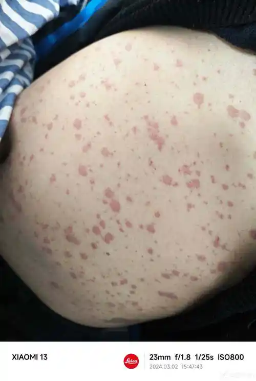 患者55岁男反复发热3天后出现皮疹压之褪色