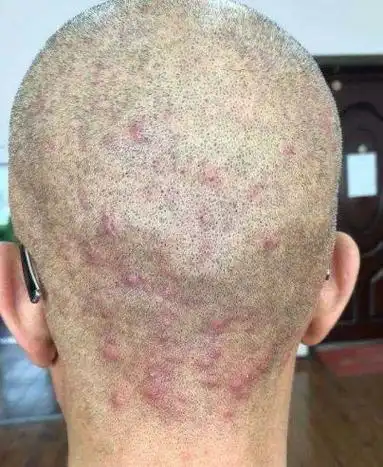 毛囊炎的症状和图片 - 搜狗图片搜索