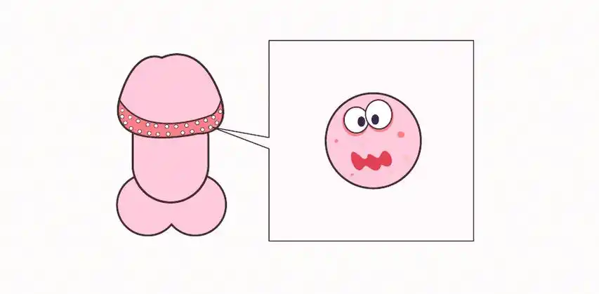 消帮主健康科普丨jj长了小疙瘩是不是得了性病