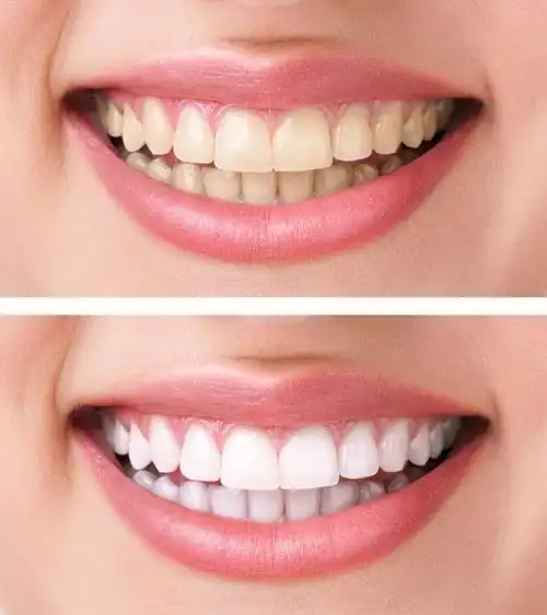 美白前后女人的牙齿