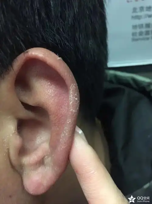 大屁股耳朵脱皮啦～吃饭好贵,吃个拼盘 两杯鸡尾酒…加上各种税…差不