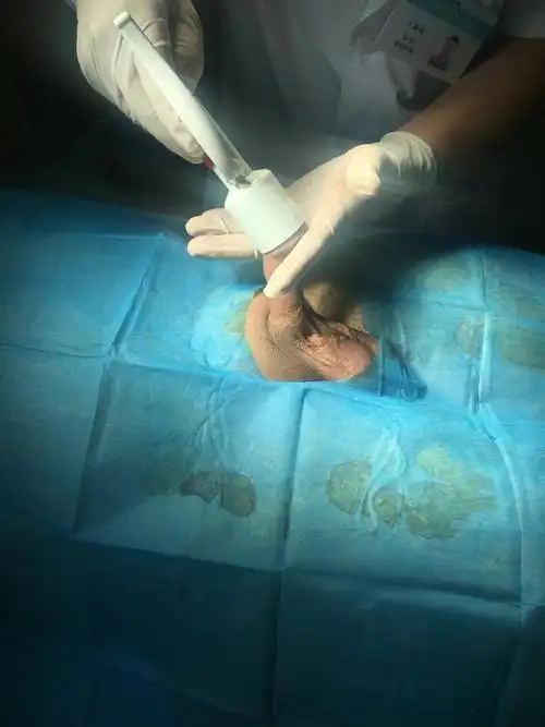 实图一一包皮环切 1