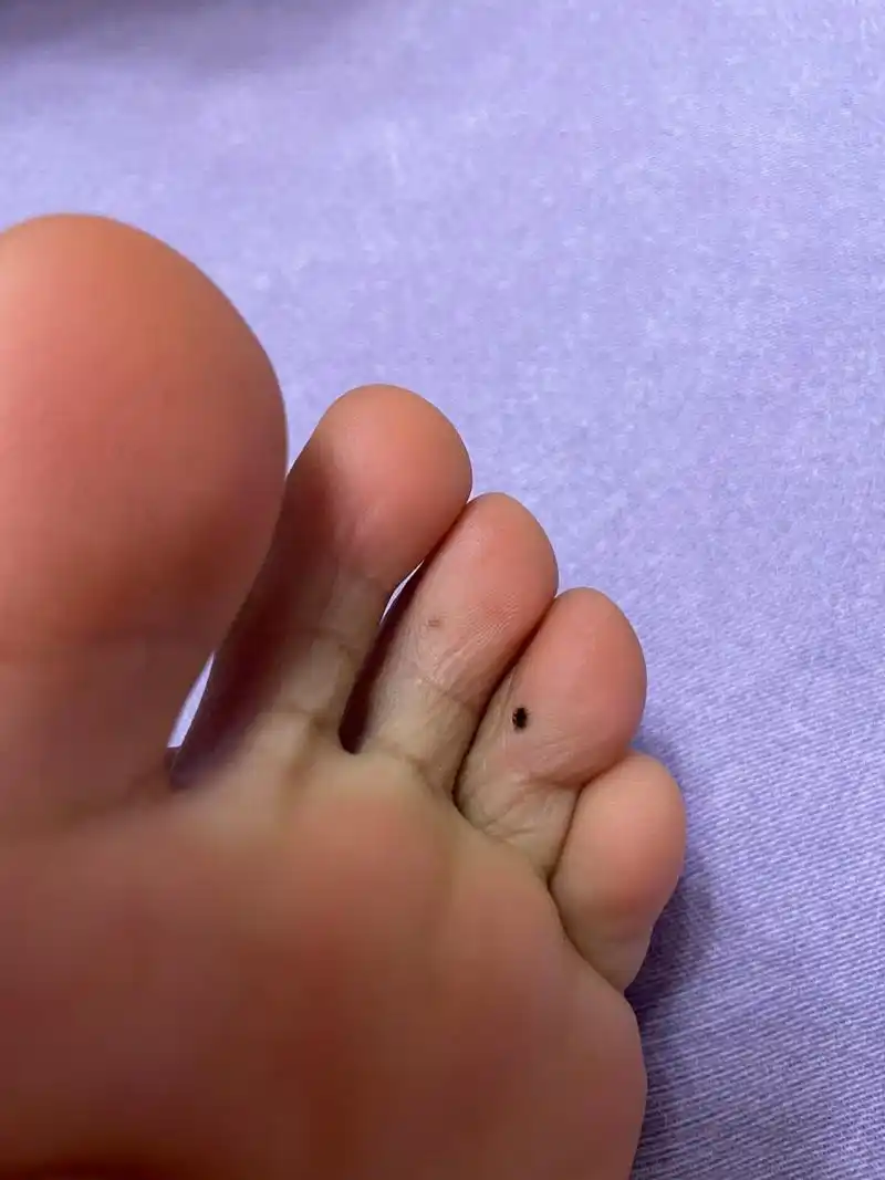 脚上的痣?