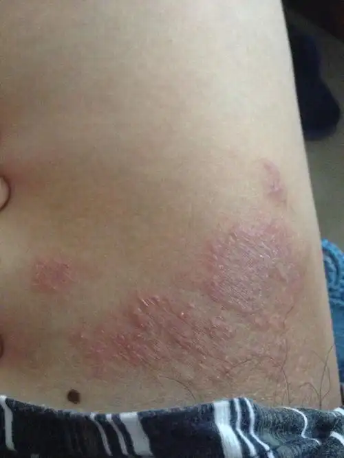 大腿根这是起的什么东西 很痒痒 是股癣吗?