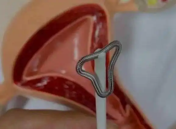 适合大龄!所有节育环的形状图片大全"千辛万苦"-第2张图片-陌上花网