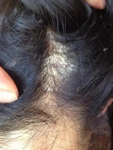 我头上长了一块像头皮藓一样的东西.请帮我看一下,是什么?该怎么治疗?