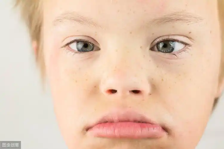 眼距宽的ta们是国际统一面孔,唐氏高风险胎儿的去留,由谁来定?