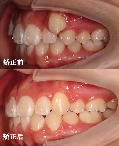 再见小尖牙,虎牙矫正结束啦~69