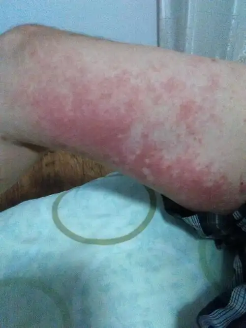 全身起红斑,甚痒,一个月了用药没效果.起皮一层一层的.