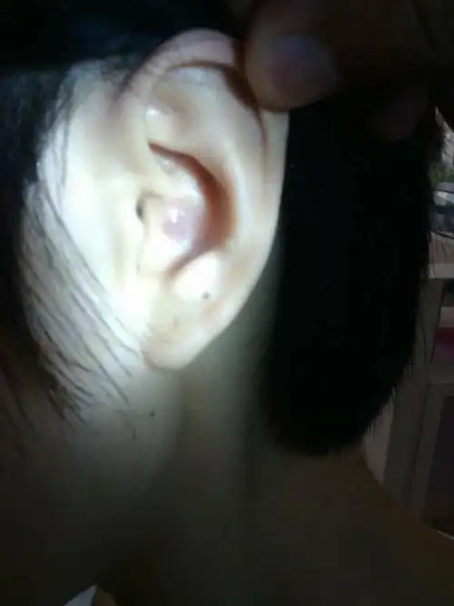 我的耳朵又长一个小圆包,不知道怎么回事,去年是那只耳朵,现在是另外