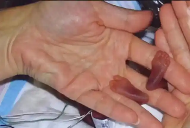 曾用蛋壳当摇篮的"史上最小婴儿",14年后大变样,网友:不敢信