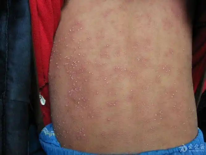 全身脓疱急性泛发性发疹性脓疱病