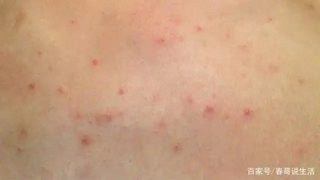 乙肝人群,身体频频亮起"3盏"红灯,检查一下吧