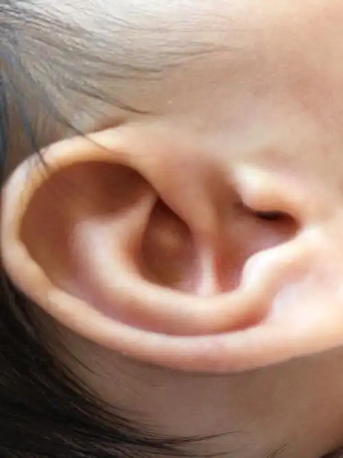 今天发现宝宝耳廓上起了个白色的包,不知道是什么