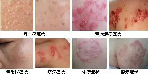 常见皮肤病的种类及症状图片
