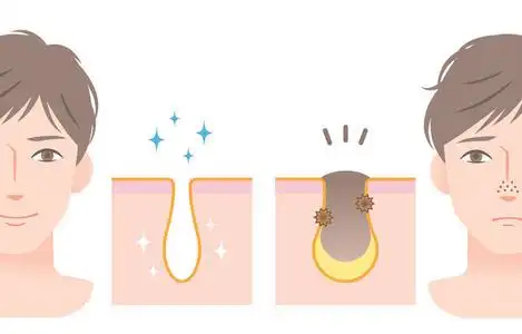 鼻子堵塞清洁毛孔和堵塞毛孔的年轻男子的脸上.男士护肤前后照片