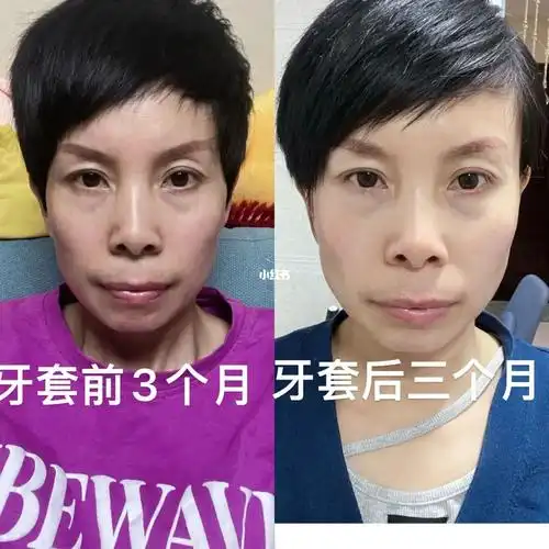 牙套前后三个月姐妹们嘴凸没变化