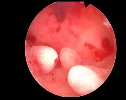 近期妇科彩超,血常规(术前一个月内有效),白带常规(术前5天内有效)