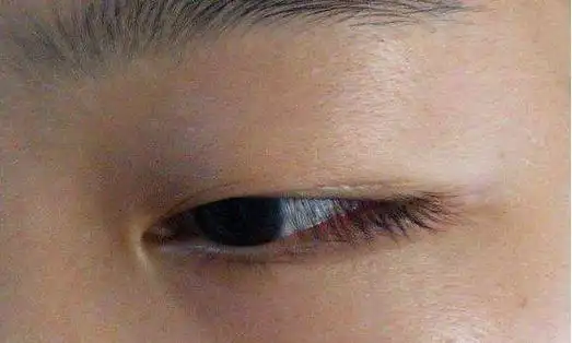 眼睑浮肿