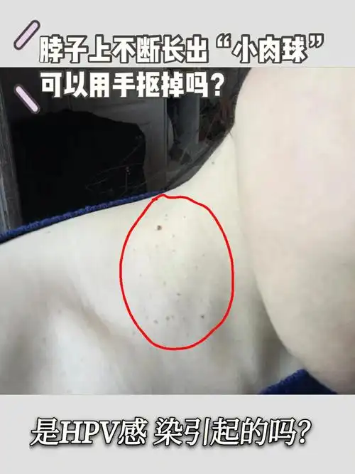 这是一种很常见的传染性疾 病,临床上被称为"丝状疣"