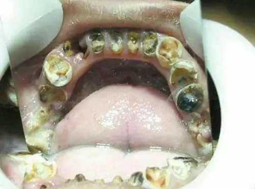 为了保护孩子的牙齿 我们该怎么做?