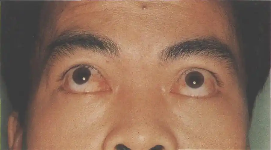 (图) 与图8-2同一患者.当上视时双侧眼球突出和巩膜暴露