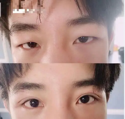 作为一个爱美的男生来说,切了双眼皮就像发现了新大陆,当时没有多选择