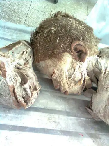 大体标本 - 临床病理讨论版 - 爱爱医医学论坛