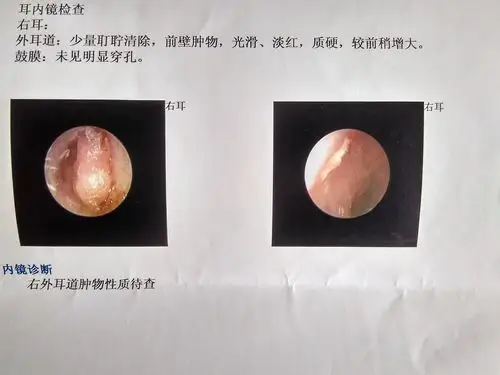 两年前发现外耳道肿物广东省医院ct检查为外耳道软骨瘤检查