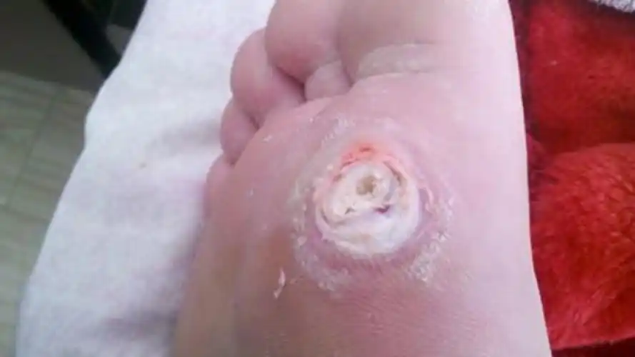 脚上长鸡眼的图片