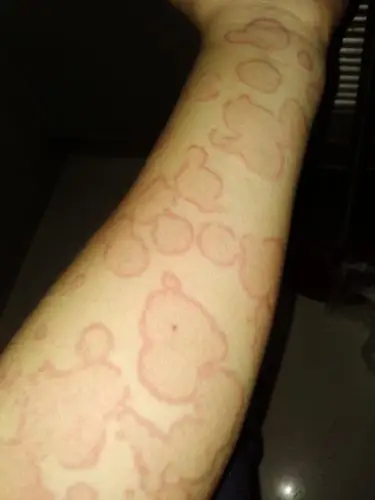 临床第三区 69 皮肤及性传播疾病讨论版 69 求助,这是荨麻疹性