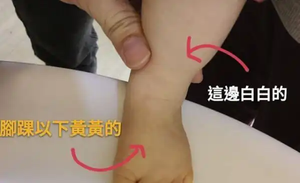 宝宝皮肤发黄, 色素沉淀和黄疸傻傻分不清楚? 辨别黄疸一招就够了
