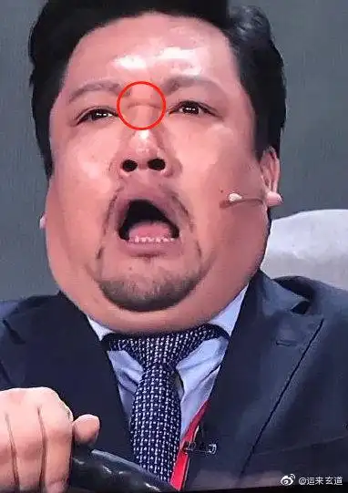 不管男女只要山根有横纹的,都会影响事业婚姻健康,但男人在事业健康方