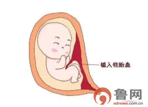 潍坊市人民医院一例凶险性前置胎盘合并胎盘植入产妇顺利分娩