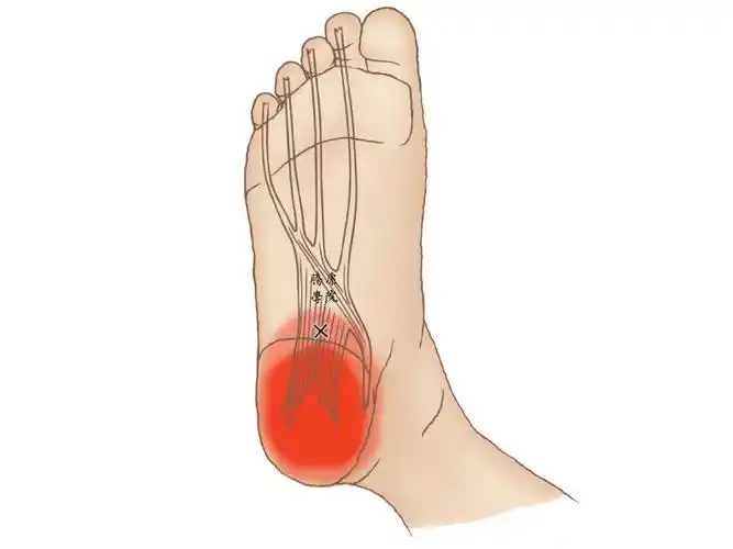 扳机点|足底方肌_肌肉
