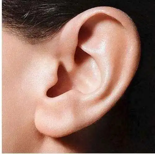 惊 | 招风耳"招财,更聪明"?医生:这是畸形耳!常见耳廓畸形有这些