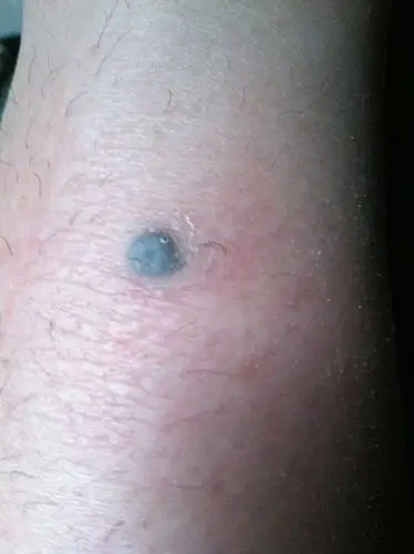 小腿边长了一颗墨绿色的,有点像痣一样的,但颜色有点暗淡,有点凸起,不