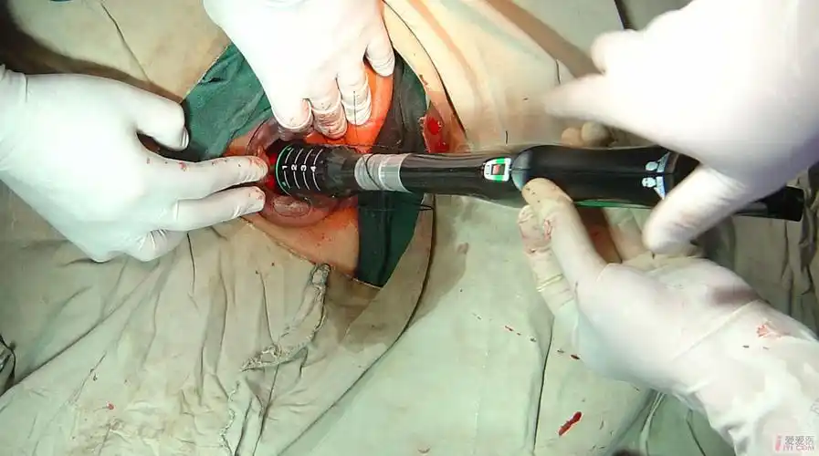 版 69 强生吻合器照片   我们医院只有强生pph手术吻合器pph03型号