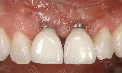 进口种植牙半口需要多少钱不同品牌相差一倍的价格都不止