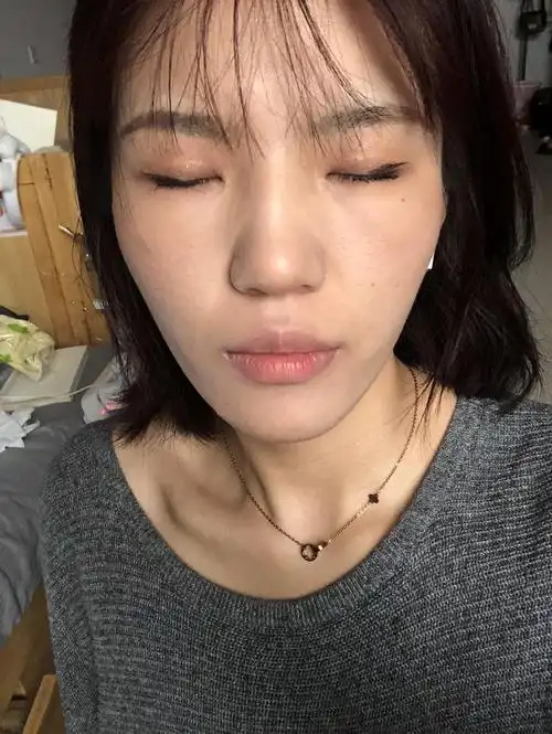 一个人去割双眼皮也可以所以分享一些经验