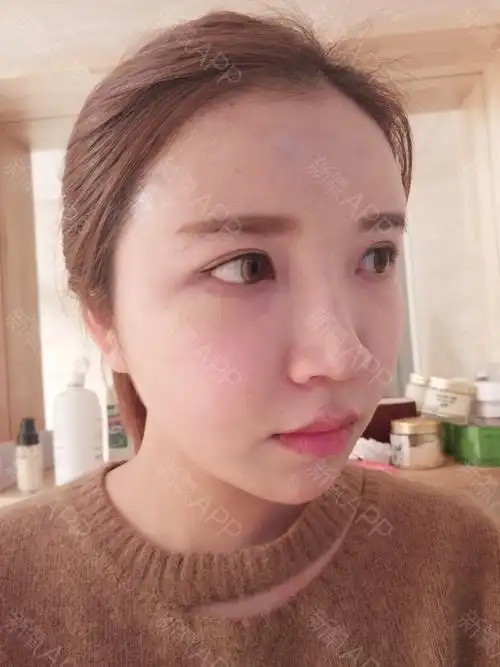 自体脂肪全脸填充第17天