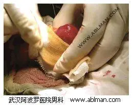 老年人包茎包皮环切手术过程直播(图) - 割包皮手术科普站