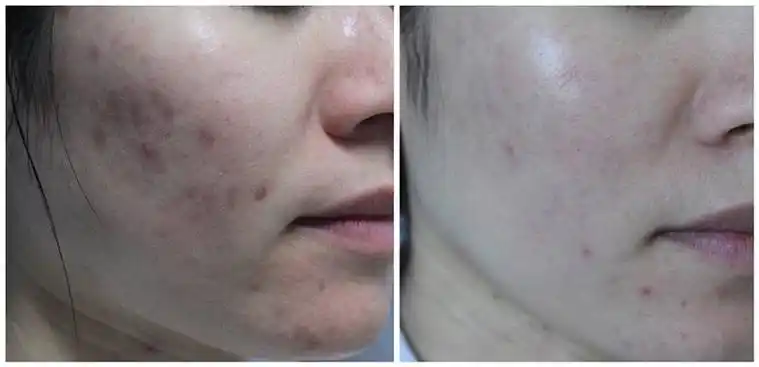 果酸换肤----让肌肤焕然新生 - 好大夫在线