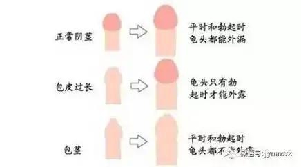 说说男生包皮包茎那些事