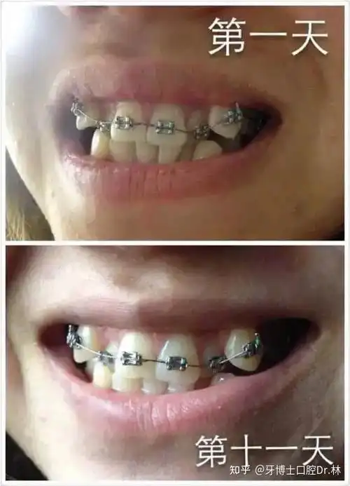 长了虎牙要进行矫正嘛