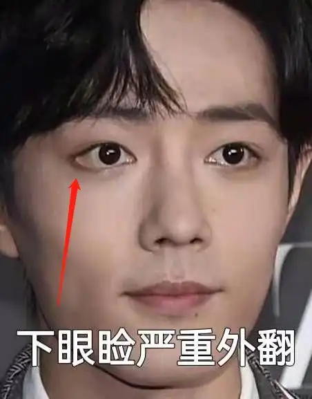 做过双眼皮我才明白这些事儿,告诉你哪里不能乱动!